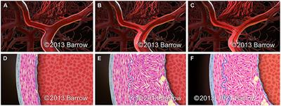 Pathophysiology of Vascular Stenosis and Remodeling in Moyamoya Disease